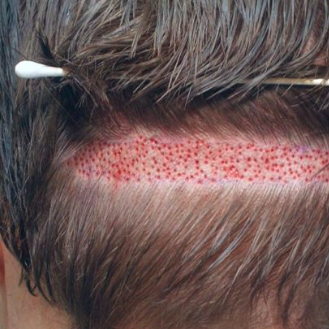 hairtransplantinPakistan